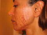 IPL burn marks